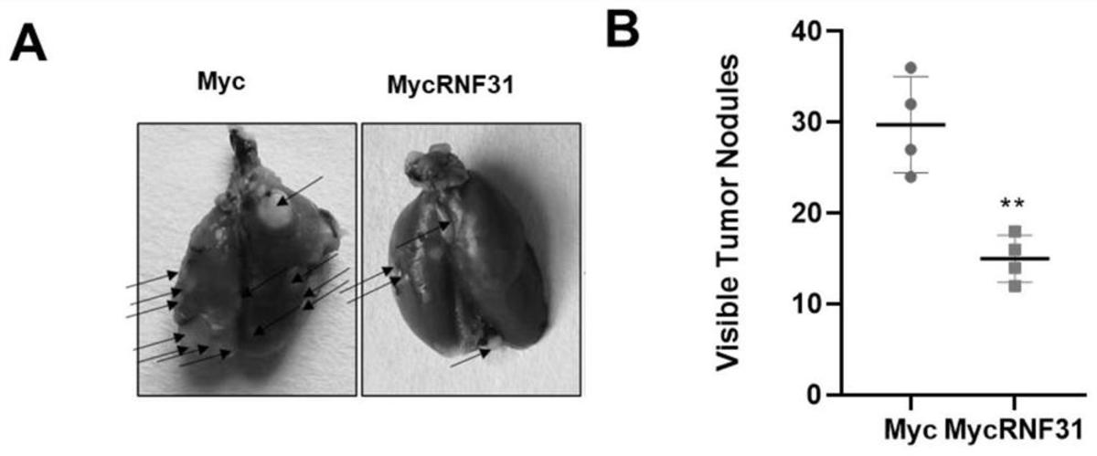 RNF31基因表达促进剂在制备治疗TNBC的药物中的应用